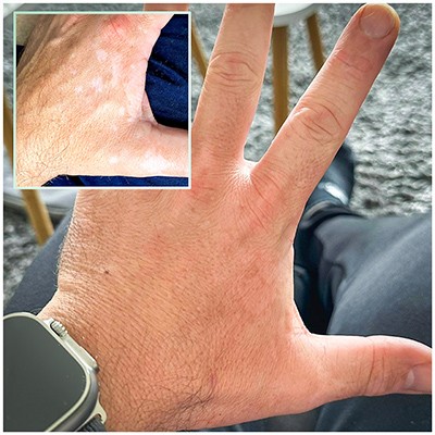 vitiligo-berlin-hand