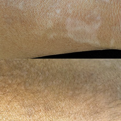 vitiligo-berlin